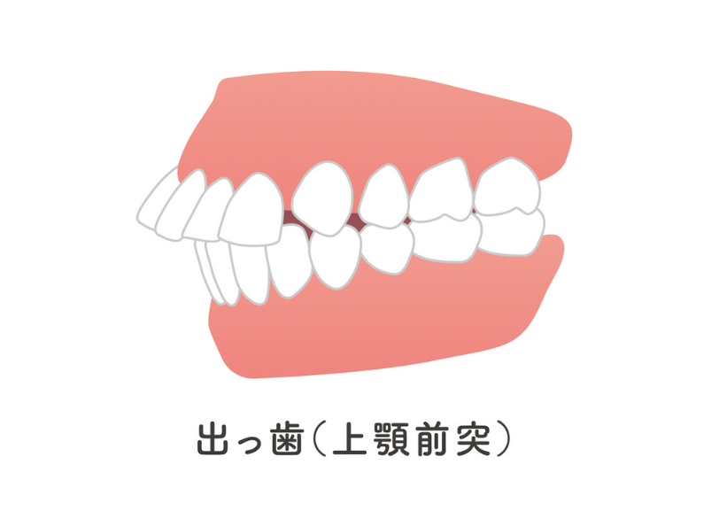 上顎前突|ブライト歯科