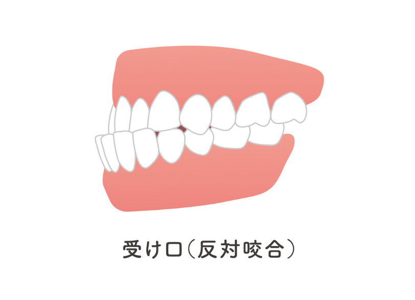 反対咬合|ブライト歯科
