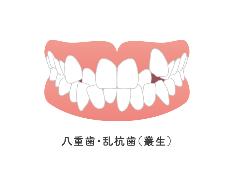 叢生|ブライト歯科