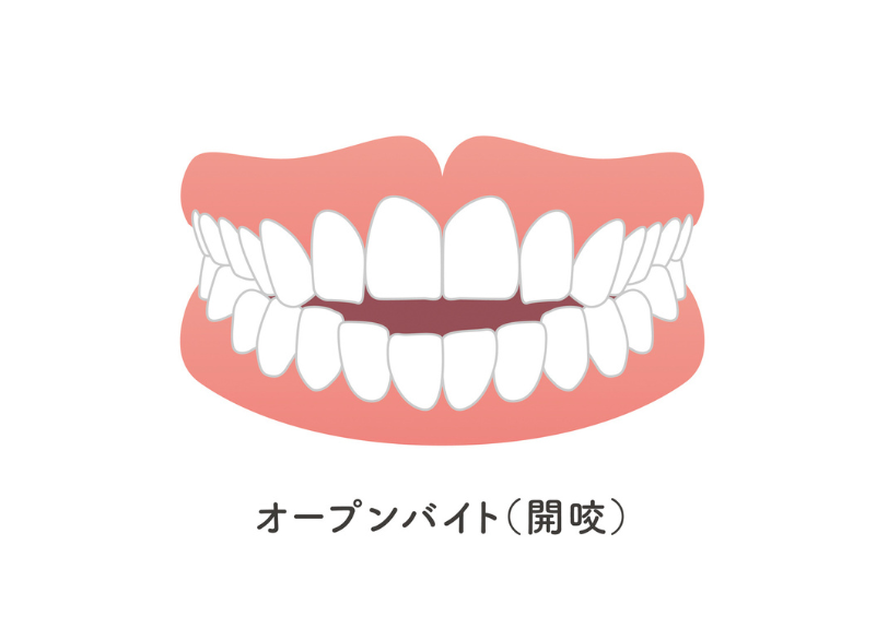 開咬|ブライト歯科