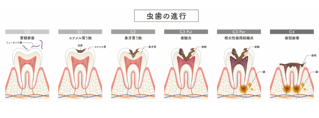 虫歯の進行|ブライト歯科