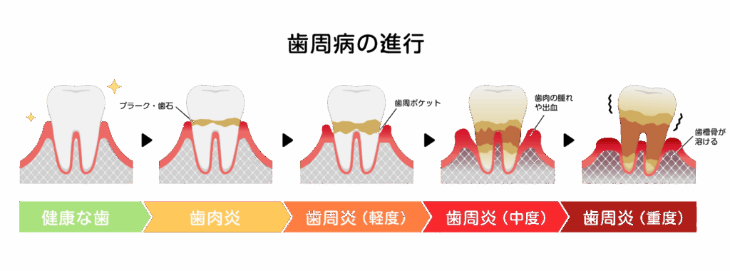 歯周病の進行|ブライト歯科