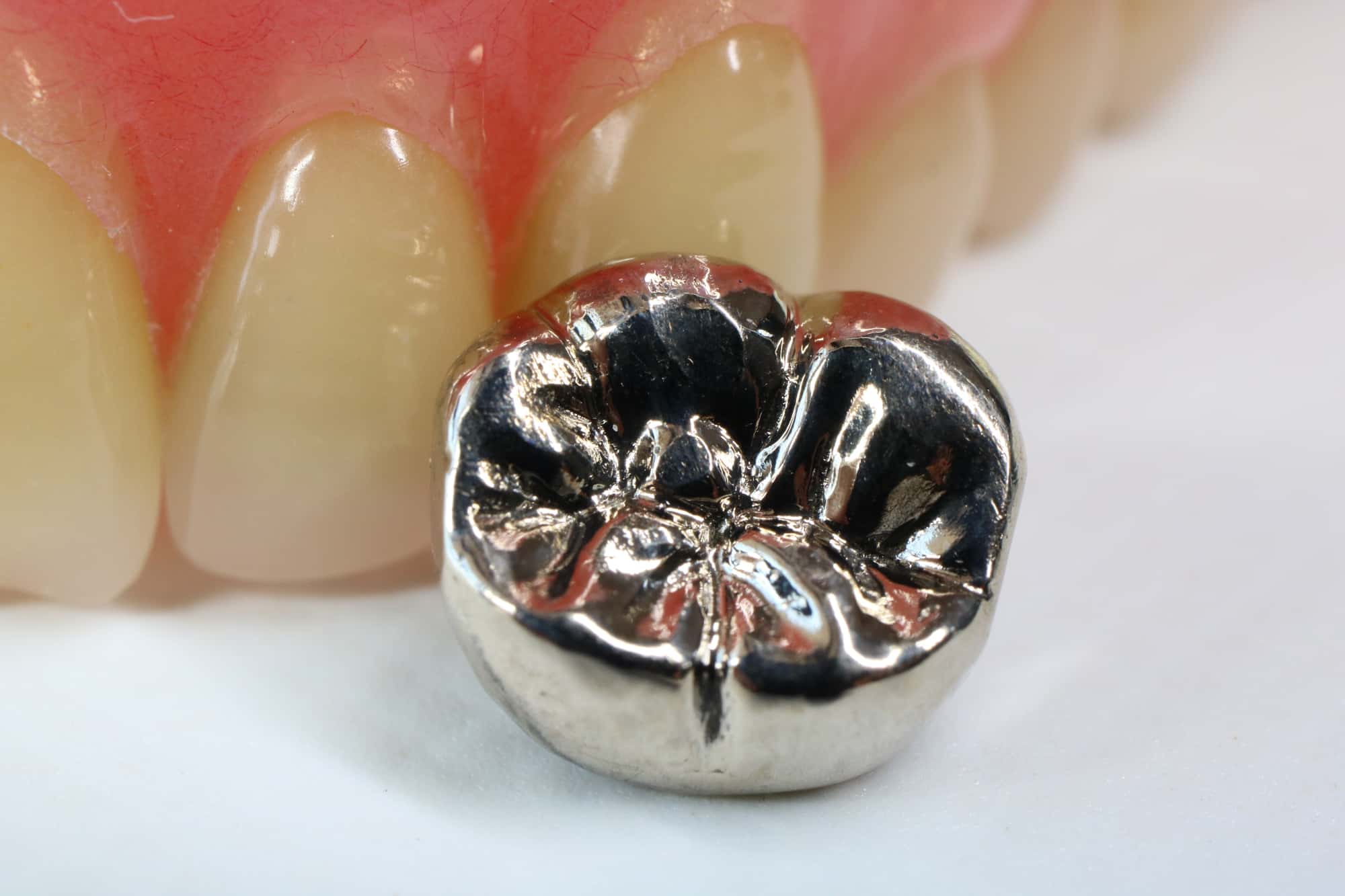 銀歯のイメージ