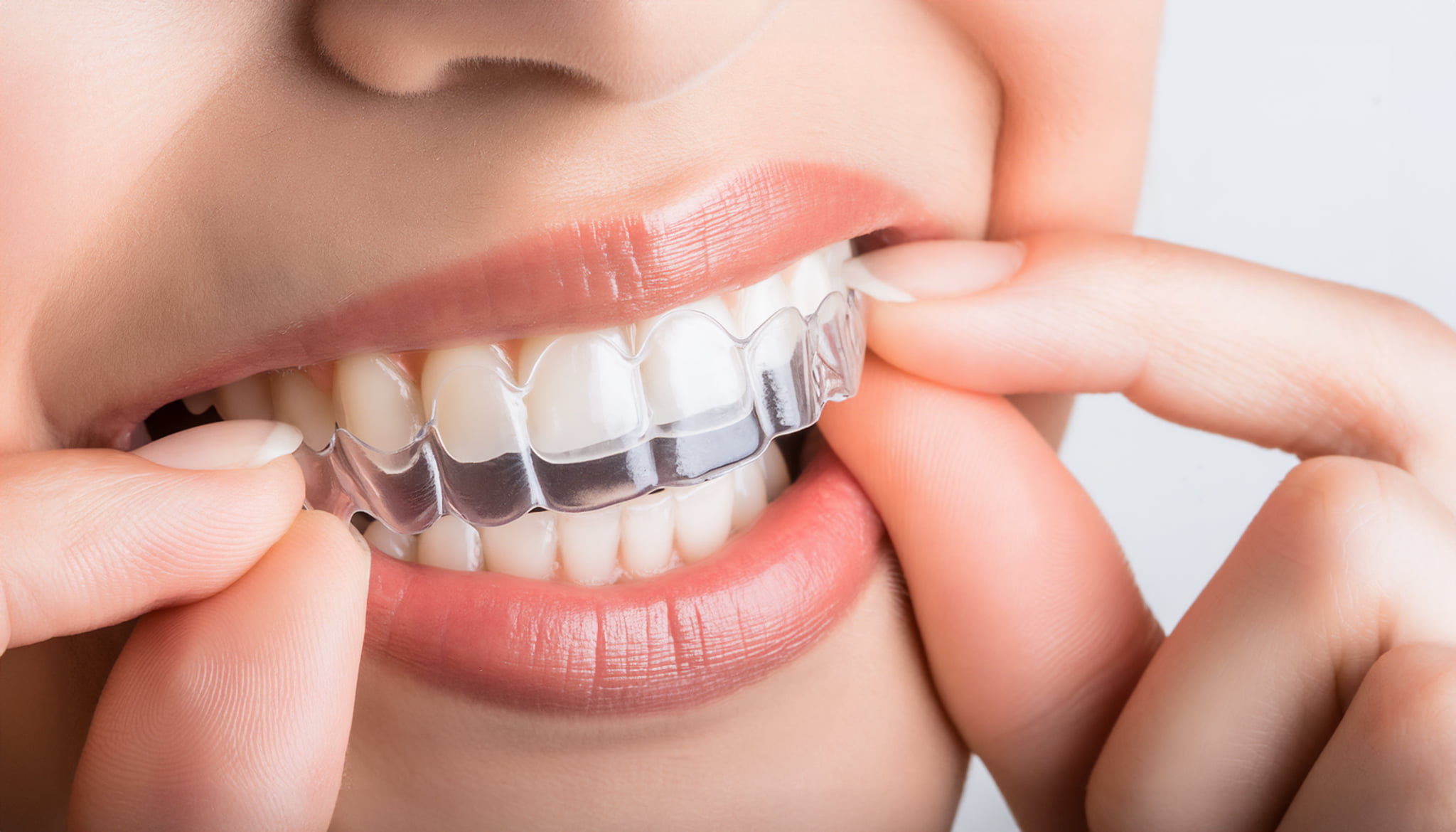 マウスピース矯正をする女性